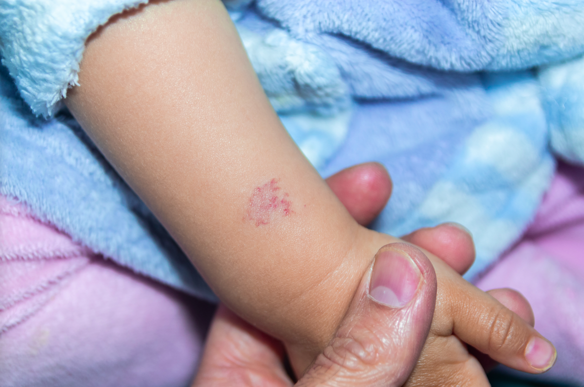 Alguns nadons poden presentar un o més angiomes FOTO: Cedida