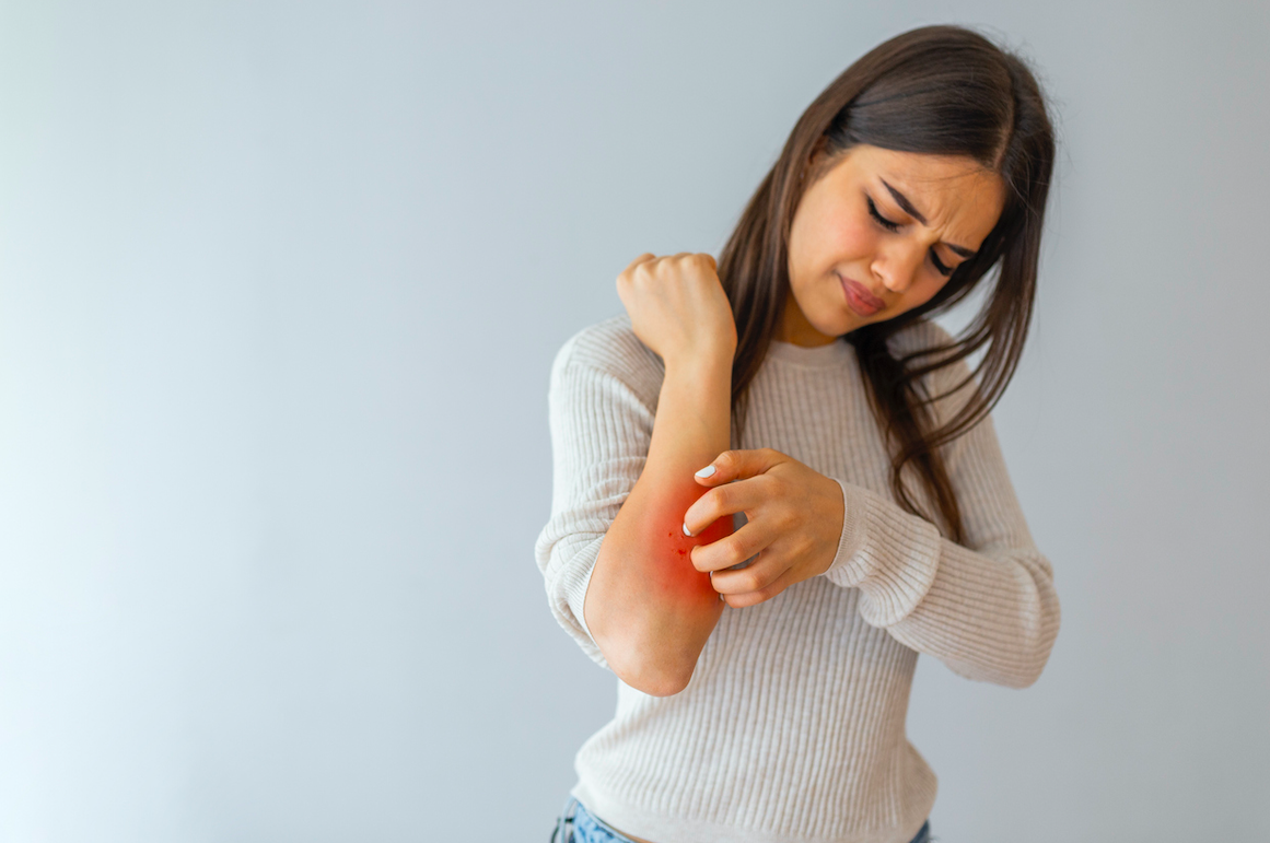 La urticària es una inflamación de la piel JODO: Cedida